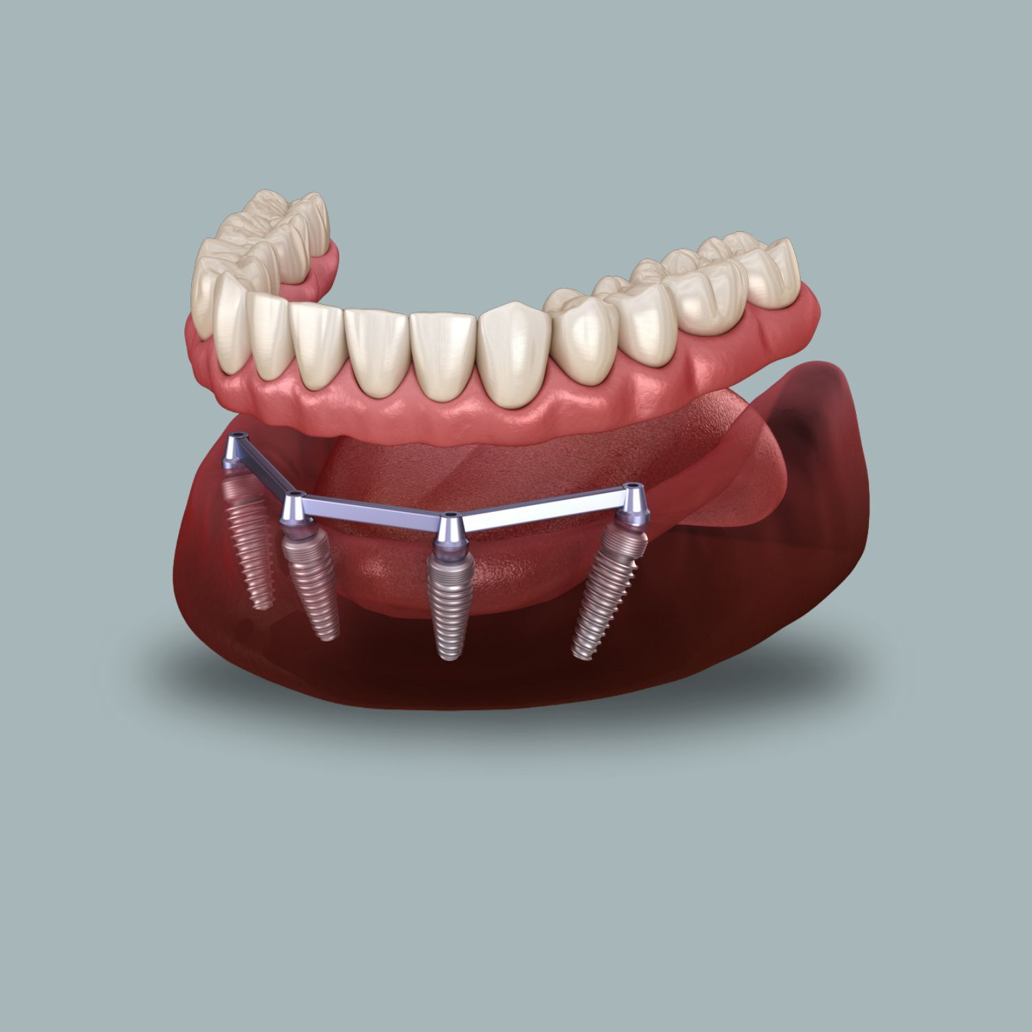 implant dentures image